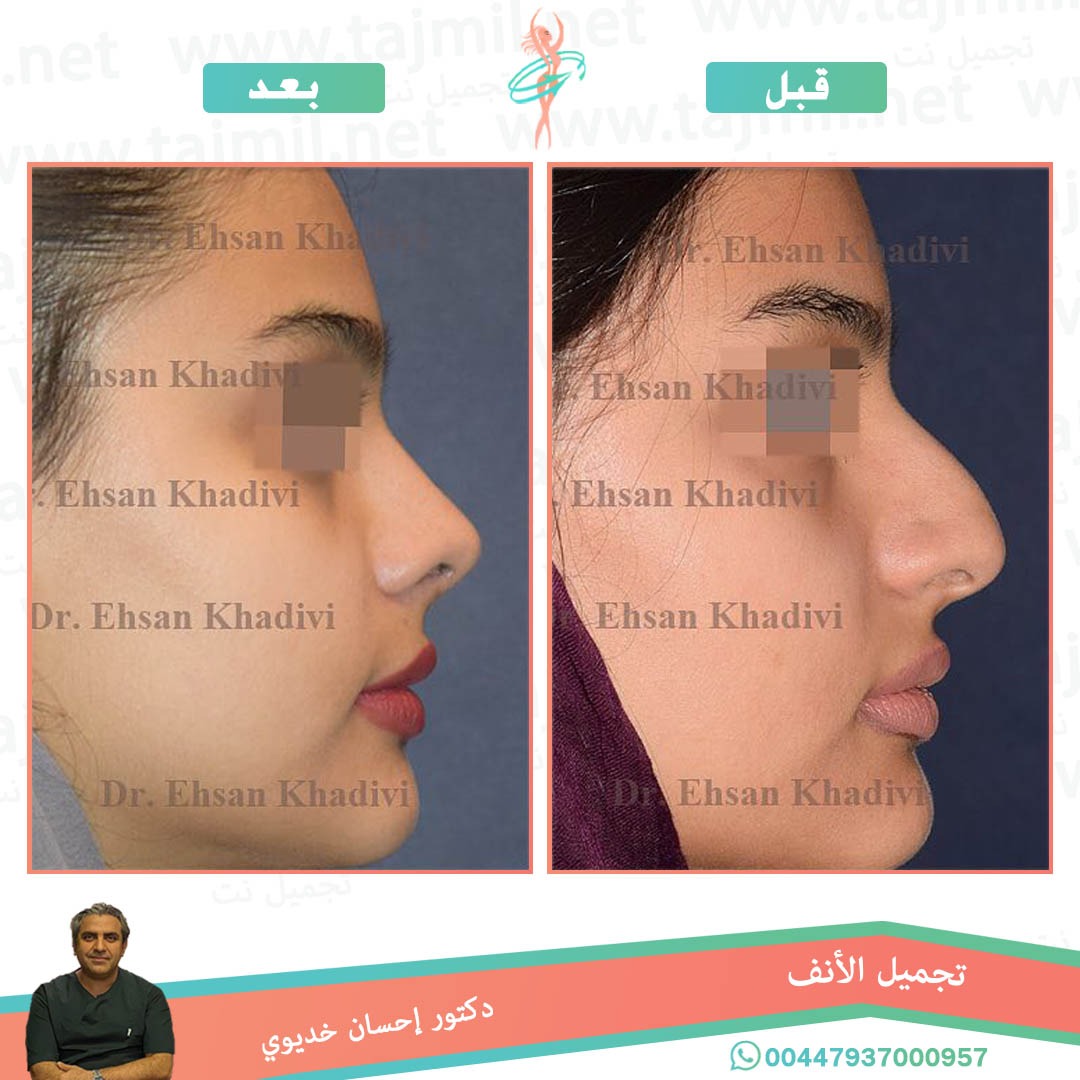  - دکتور إحسان خدیوي عملية تجميل الانف في ايران مع تجميل نت