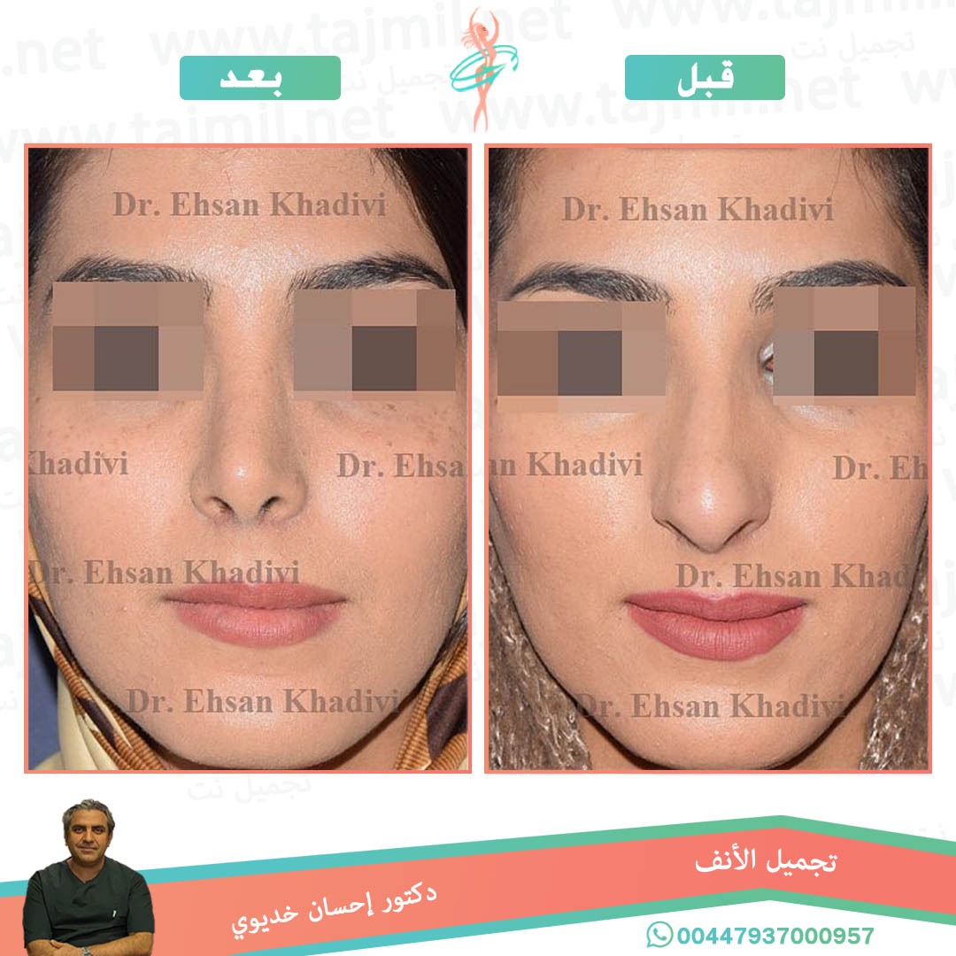  - دکتور إحسان خدیوي عملية تجميل الانف في ايران مع تجميل نت