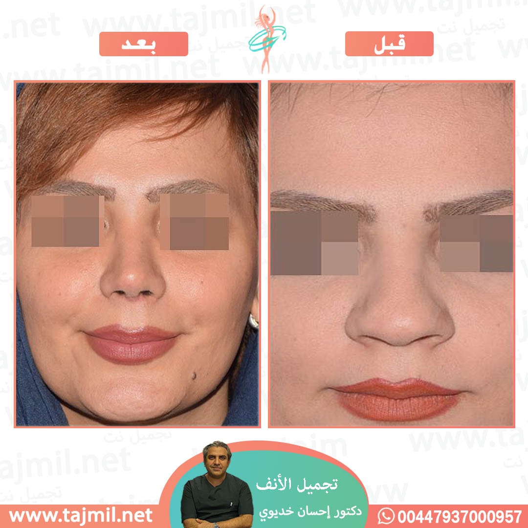  - دکتور إحسان خدیوي عملية تجميل الانف في ايران مع تجميل نت