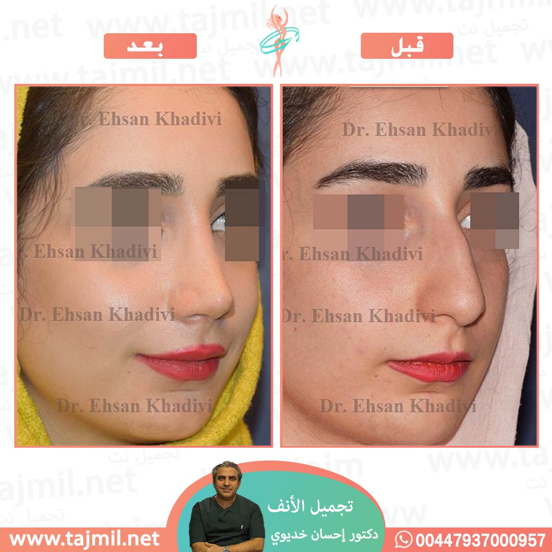  - دکتور إحسان خدیوي عملية تجميل الانف في ايران مع تجميل نت