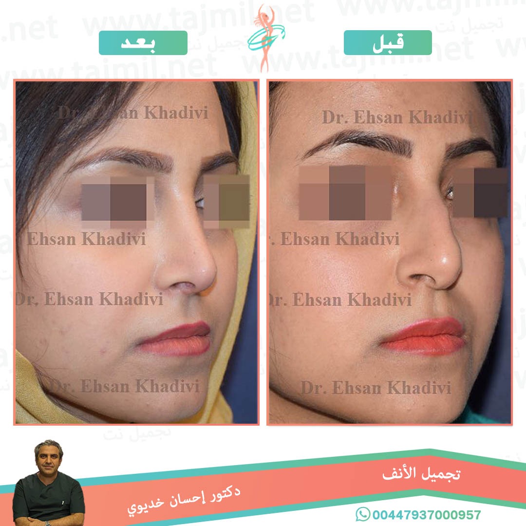  - دکتور إحسان خدیوي عملية تجميل الانف في ايران مع تجميل نت