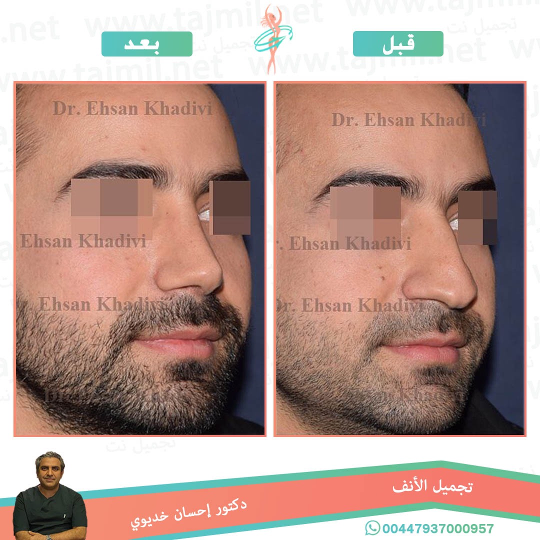  - دکتور إحسان خدیوي عملية تجميل الانف في ايران مع تجميل نت