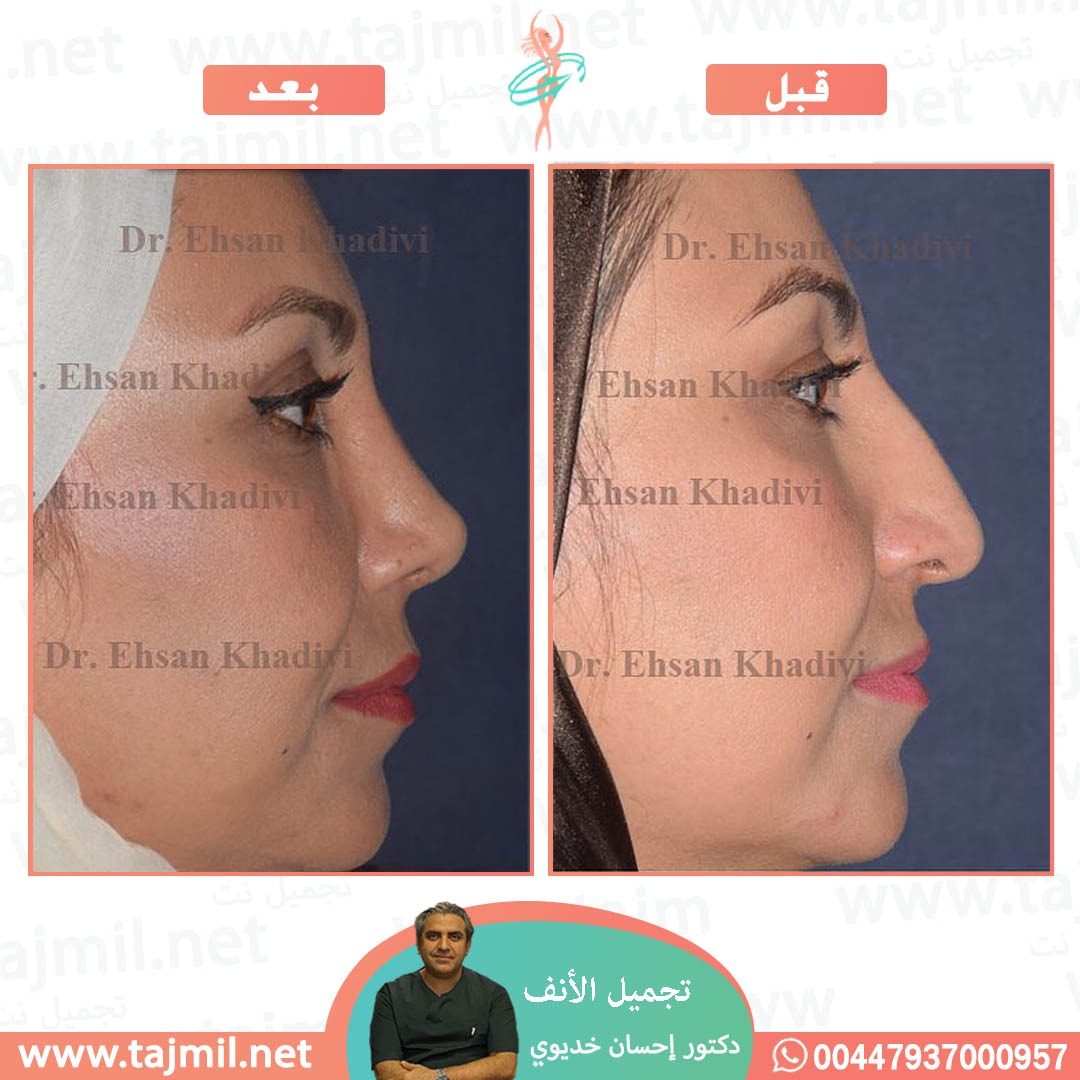  - دکتور إحسان خدیوي عملية تجميل الانف في ايران مع تجميل نت