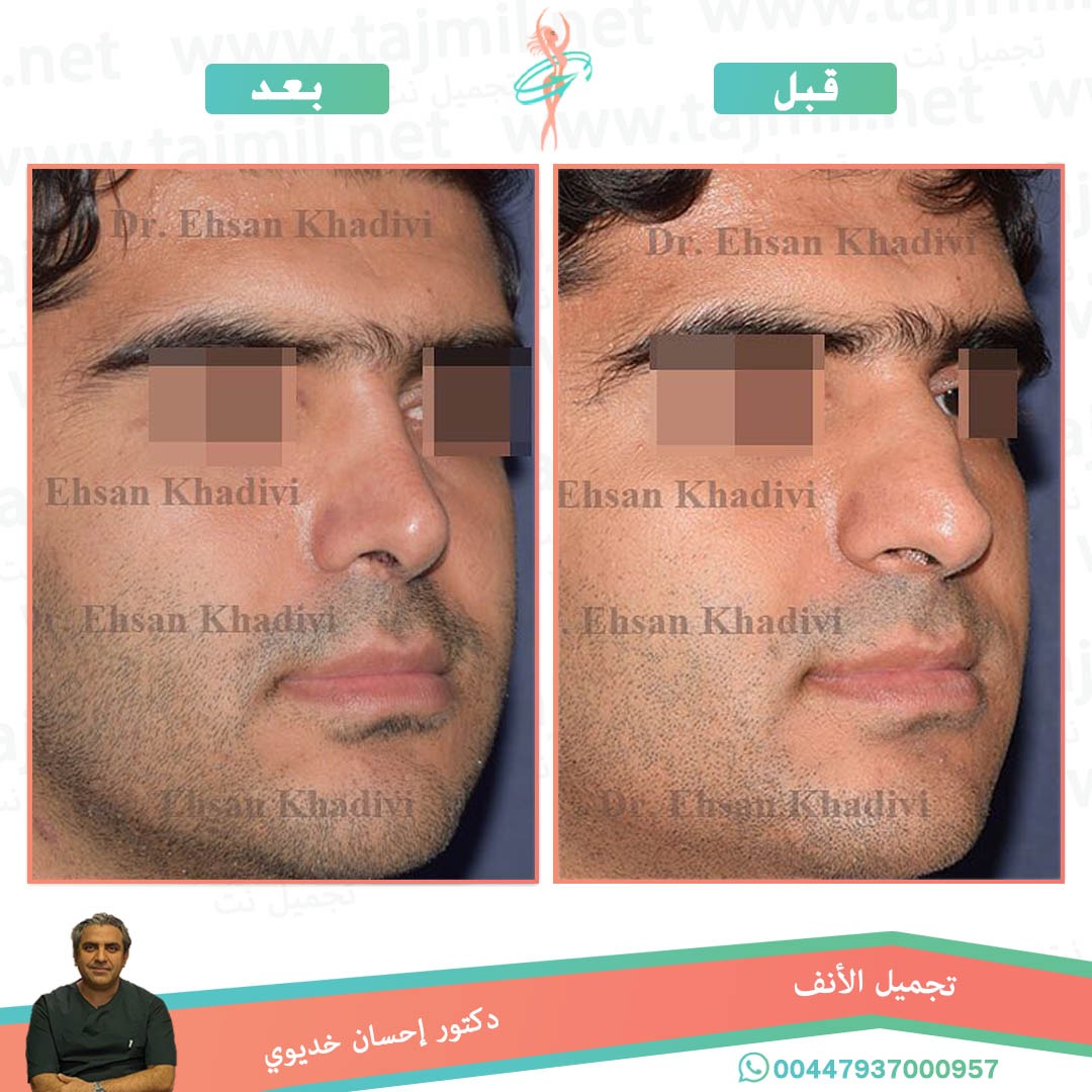  - دکتور إحسان خدیوي عملية تجميل الانف في ايران مع تجميل نت