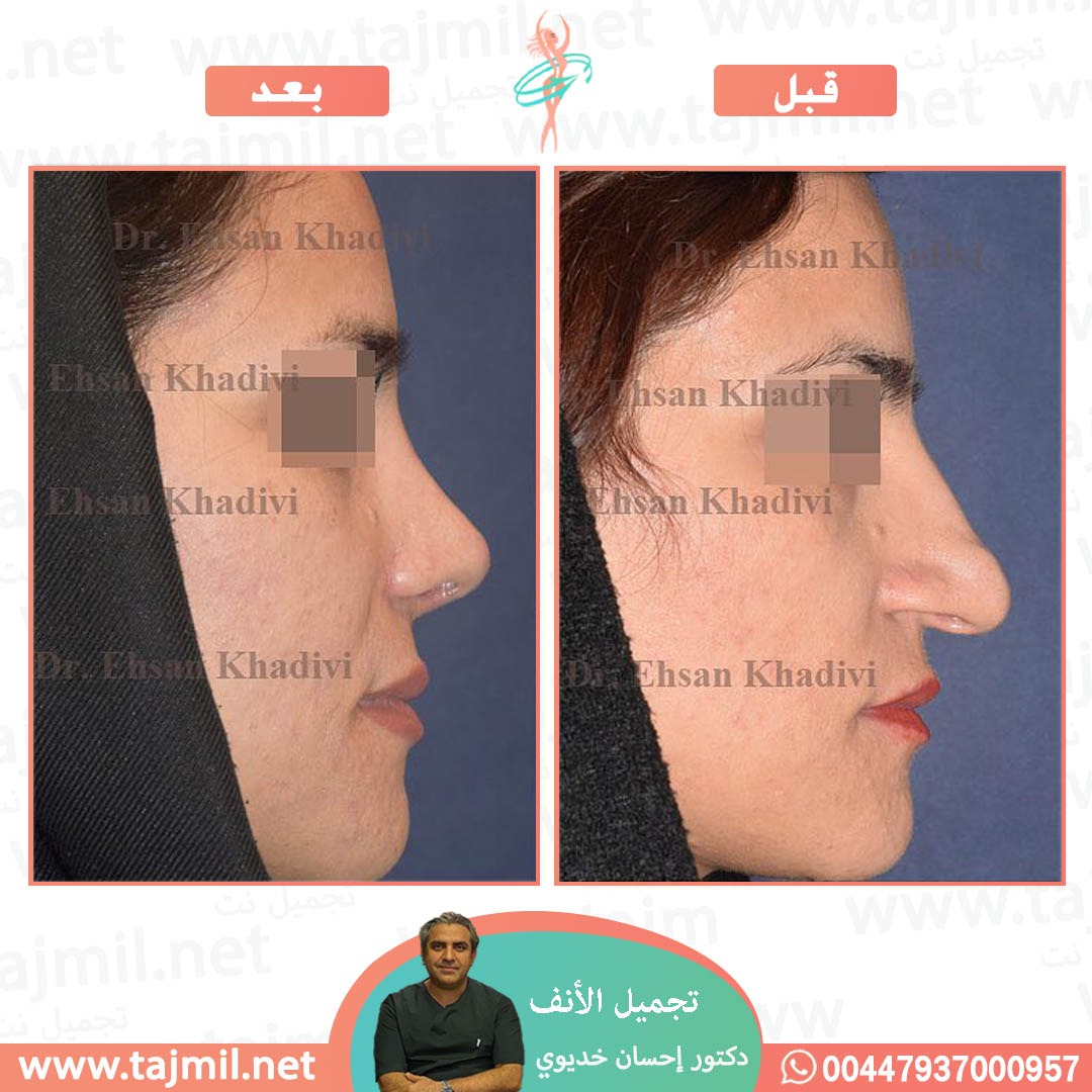  - دکتور إحسان خدیوي عملية تجميل الانف في ايران مع تجميل نت