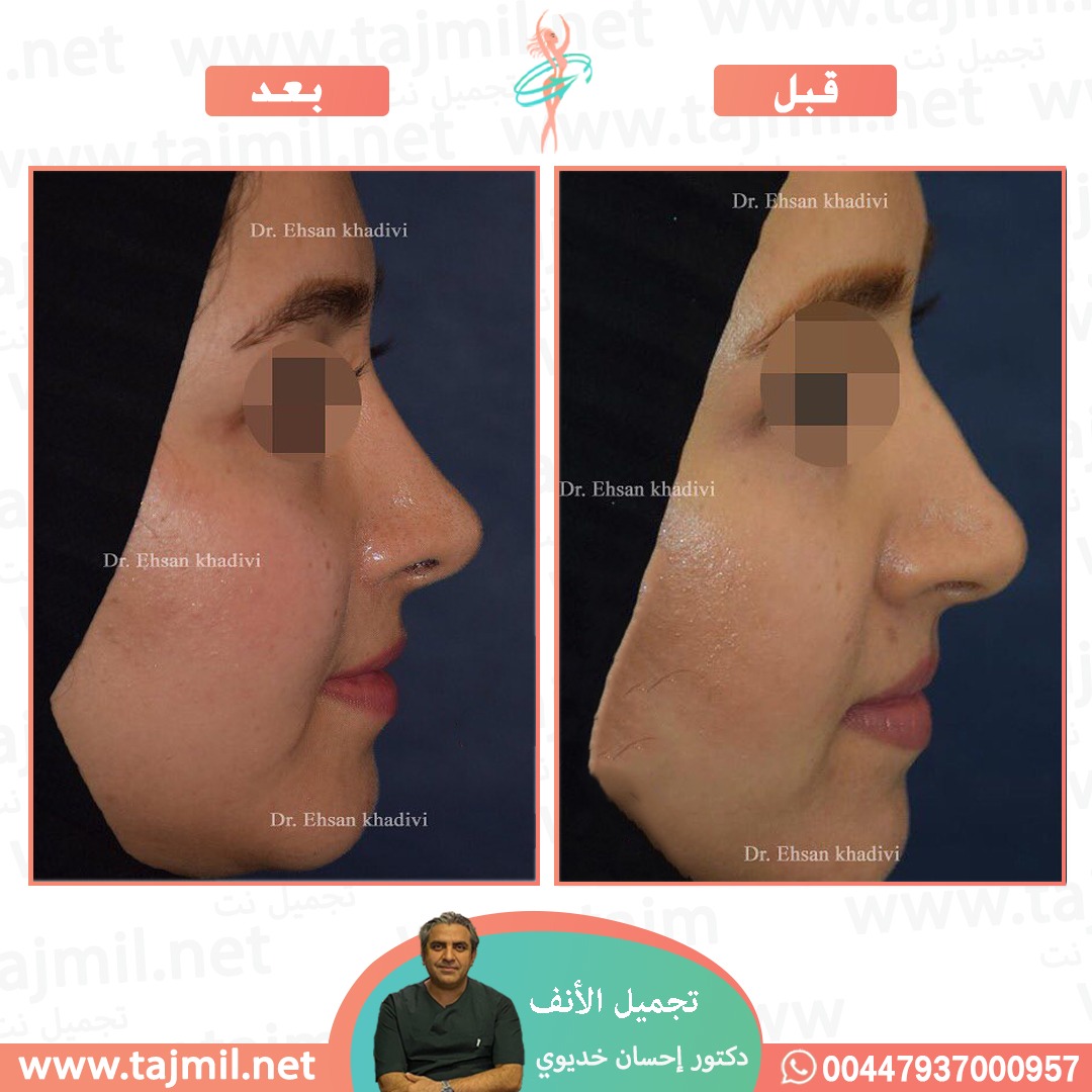  - دکتور إحسان خدیوي عملية تجميل الانف في ايران مع تجميل نت