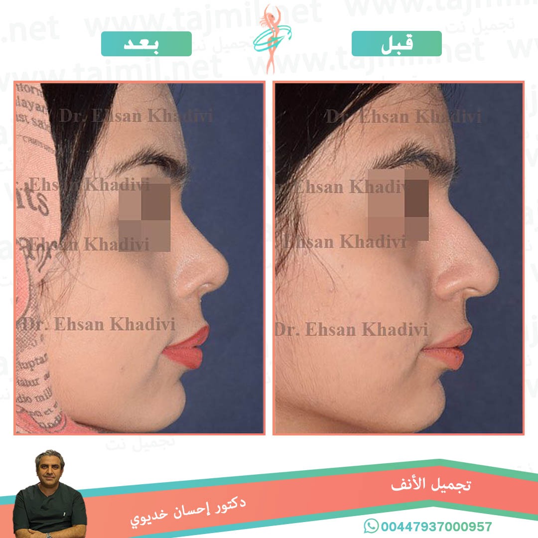  - دکتور إحسان خدیوي عملية تجميل الانف في ايران مع تجميل نت