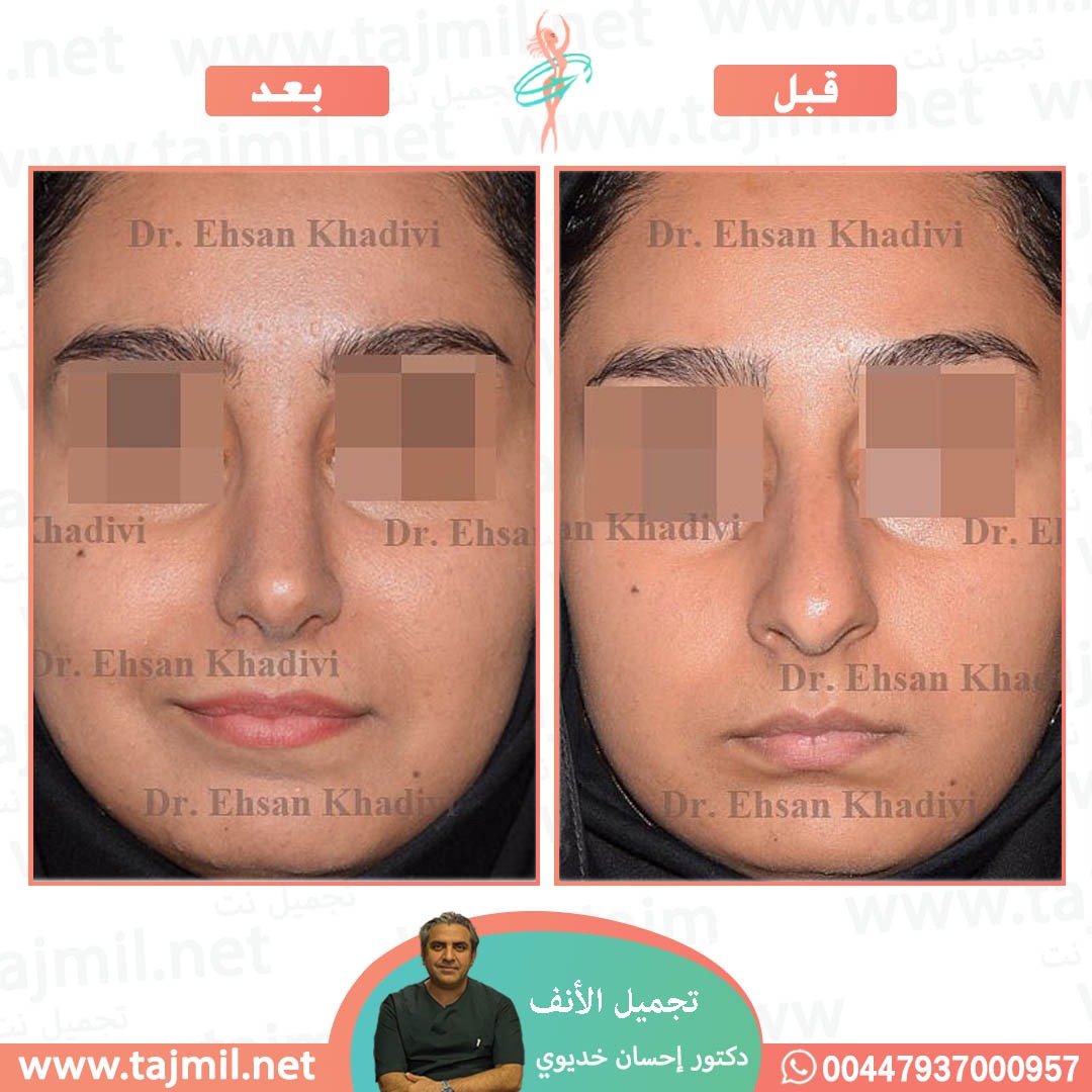  - دکتور إحسان خدیوي عملية تجميل الانف في ايران مع تجميل نت