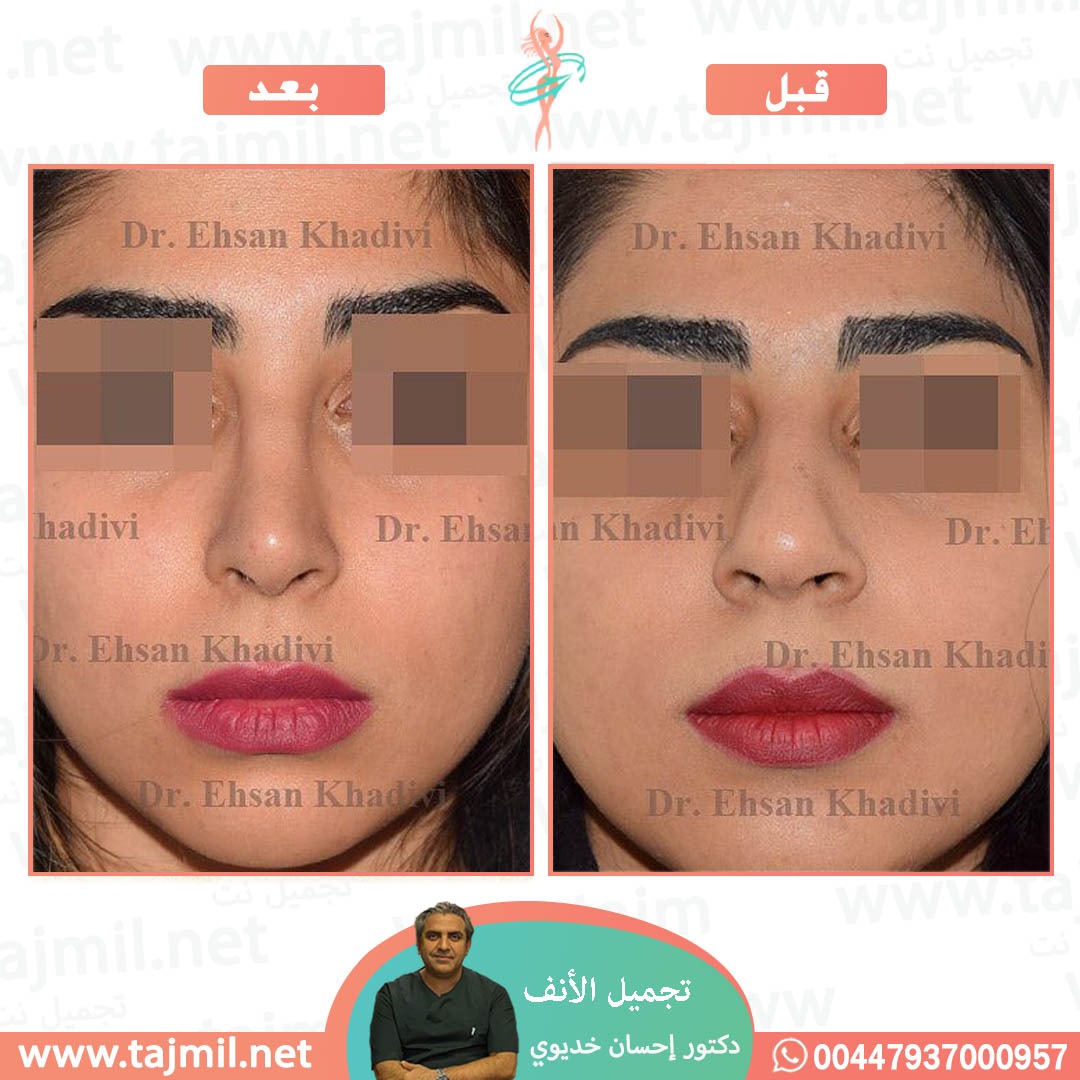  - دکتور إحسان خدیوي عملية تجميل الانف في ايران مع تجميل نت