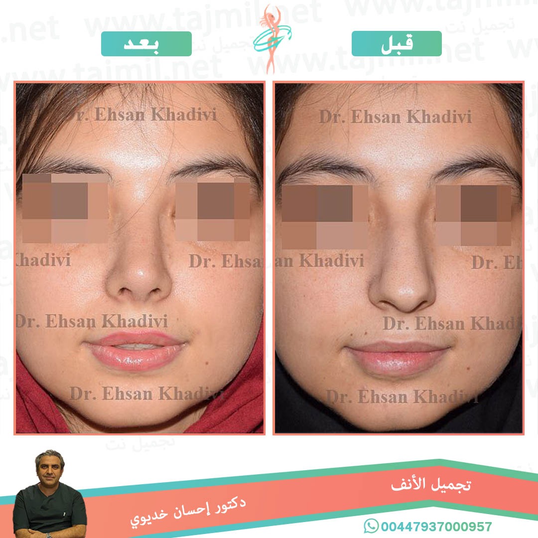  - دکتور إحسان خدیوي عملية تجميل الانف في ايران مع تجميل نت