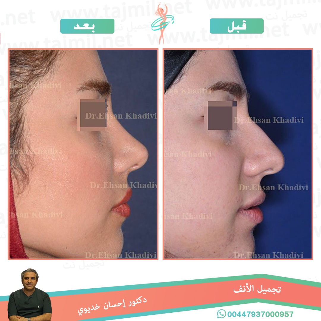  - دکتور إحسان خدیوي عملية تجميل الانف في ايران مع تجميل نت