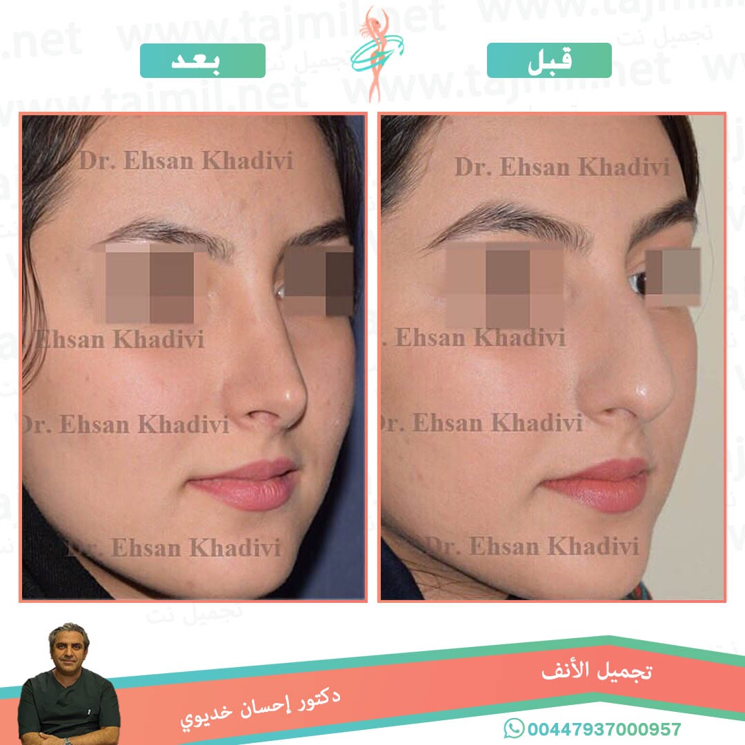  - دکتور إحسان خدیوي عملية تجميل الانف في ايران مع تجميل نت