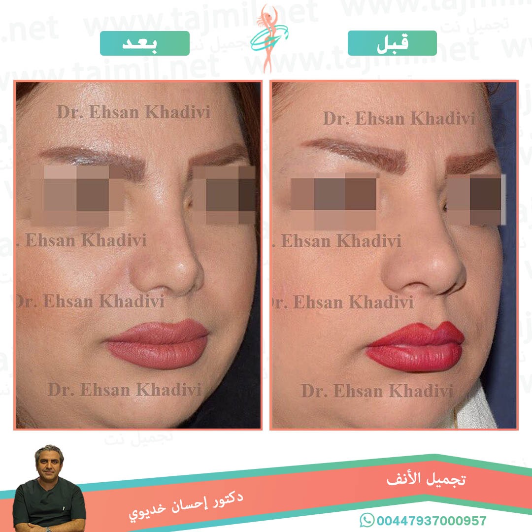  - دکتور إحسان خدیوي عملية تجميل الانف في ايران مع تجميل نت