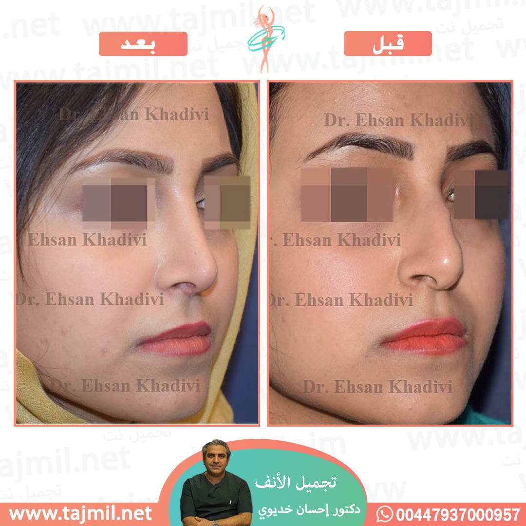  - دکتور إحسان خدیوي عملية تجميل الانف في ايران مع تجميل نت