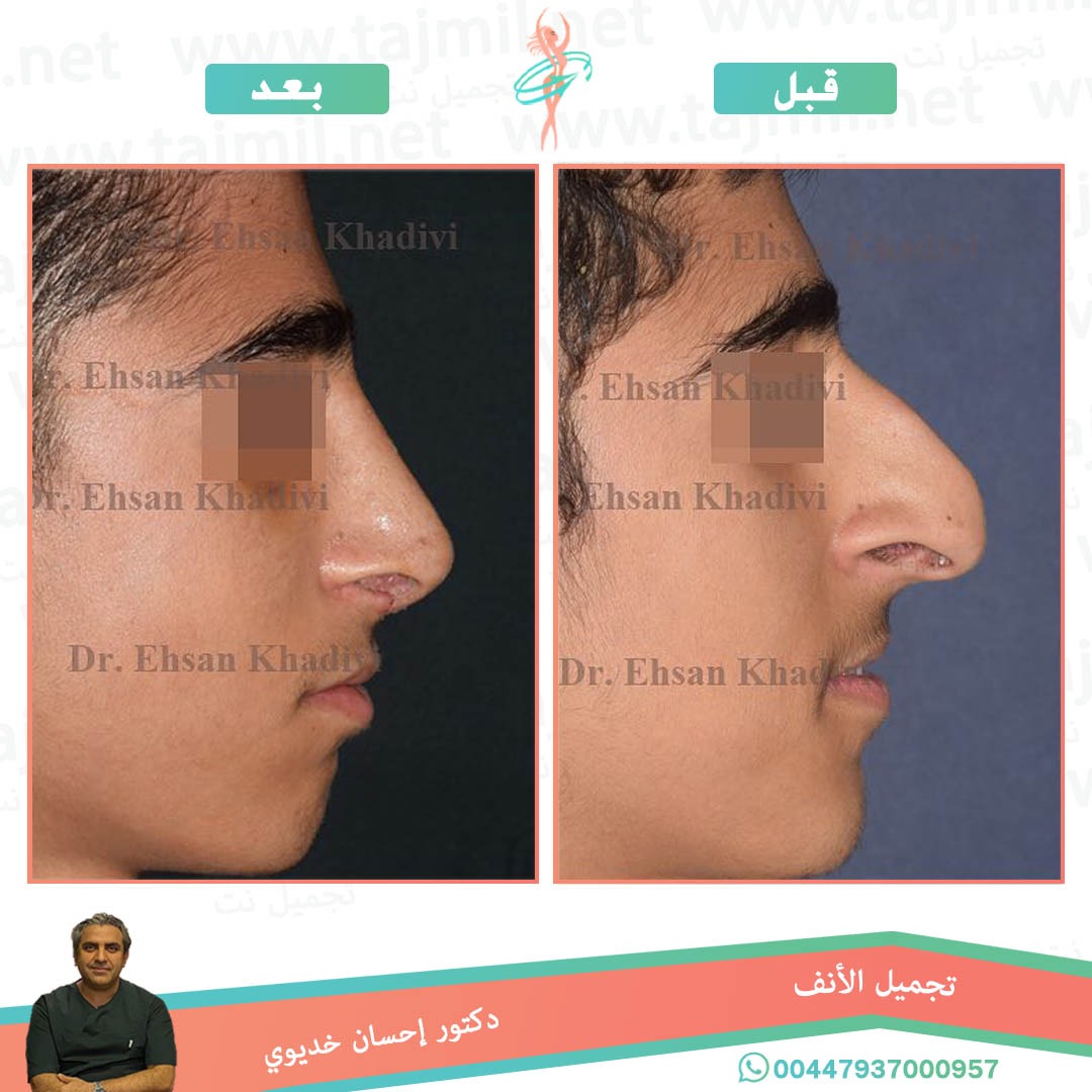  - دکتور إحسان خدیوي عملية تجميل الانف في ايران مع تجميل نت