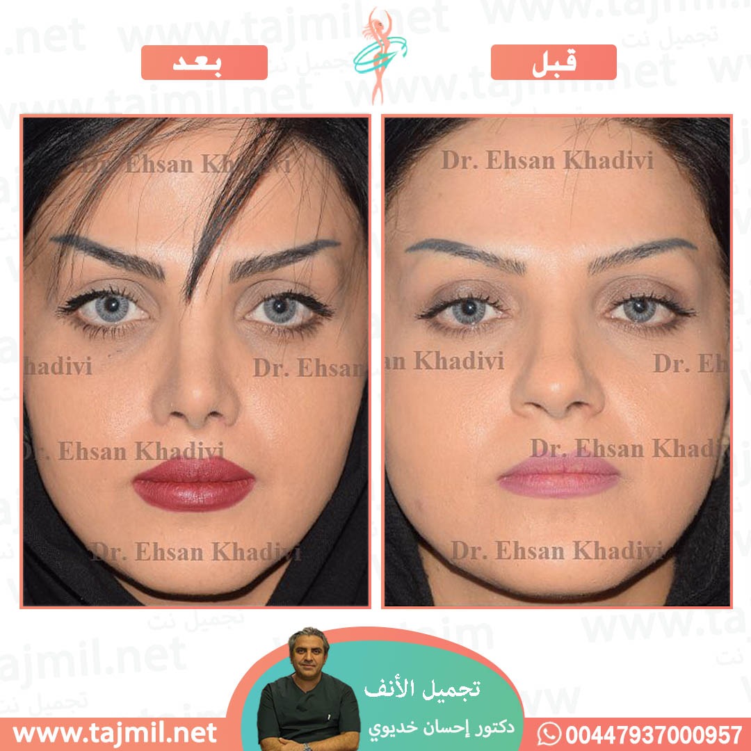  - دکتور إحسان خدیوي عملية تجميل الانف في ايران مع تجميل نت