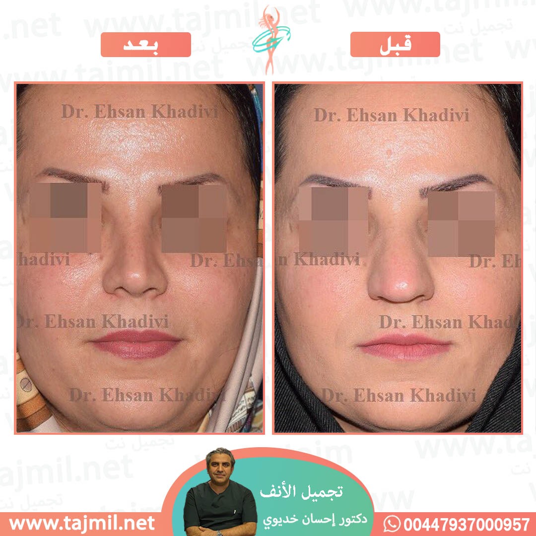  - دکتور إحسان خدیوي عملية تجميل الانف في ايران مع تجميل نت