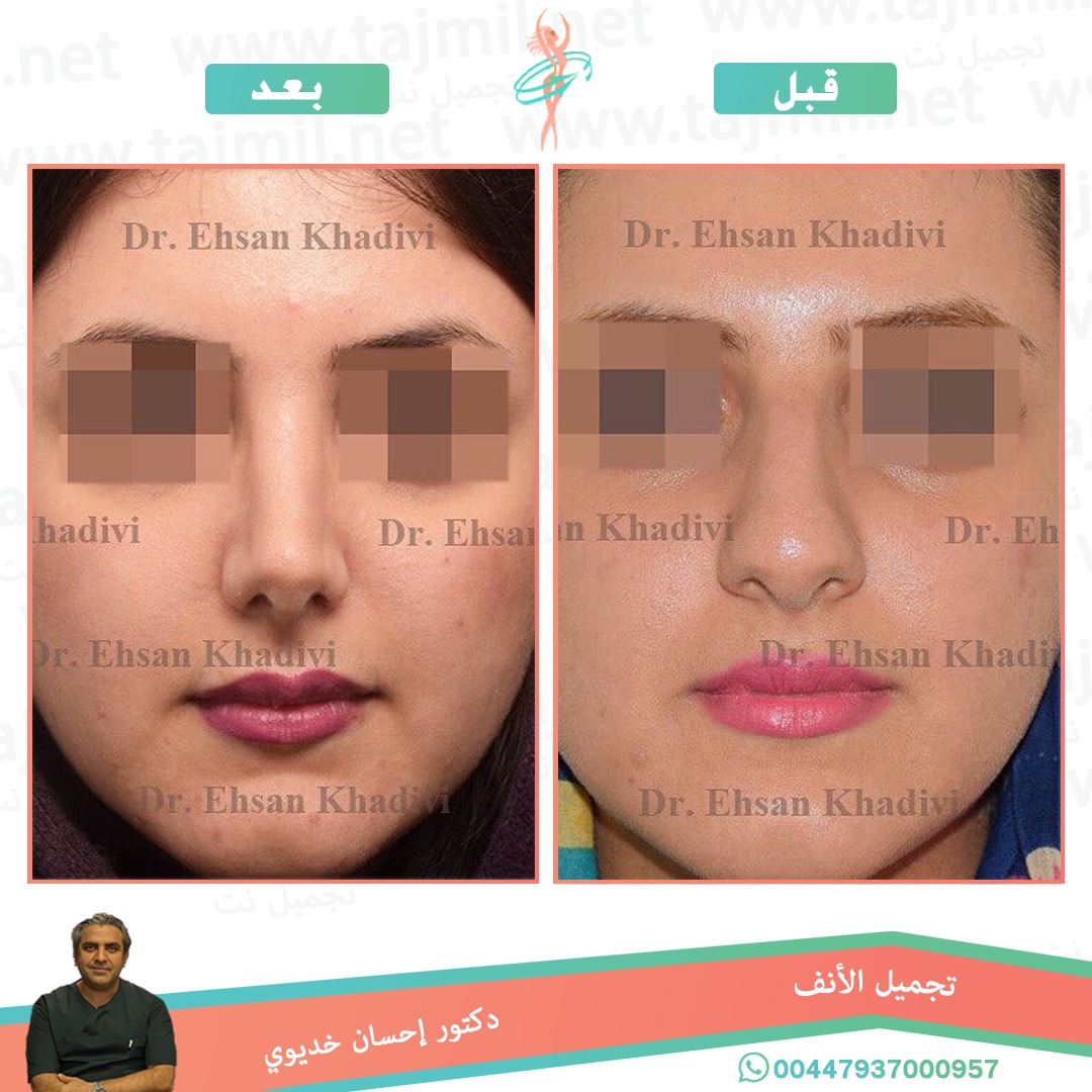  - دکتور إحسان خدیوي عملية تجميل الانف في ايران مع تجميل نت