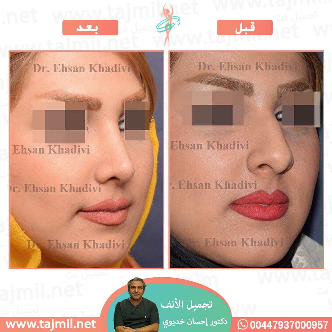  - دکتور إحسان خدیوي عملية تجميل الانف في ايران مع تجميل نت