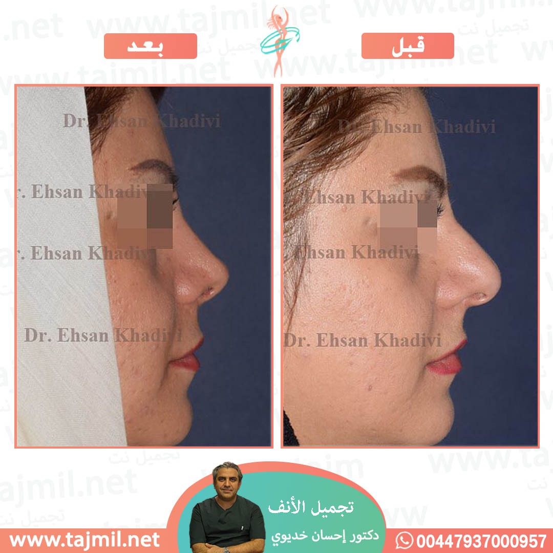  - دکتور إحسان خدیوي عملية تجميل الانف في ايران مع تجميل نت