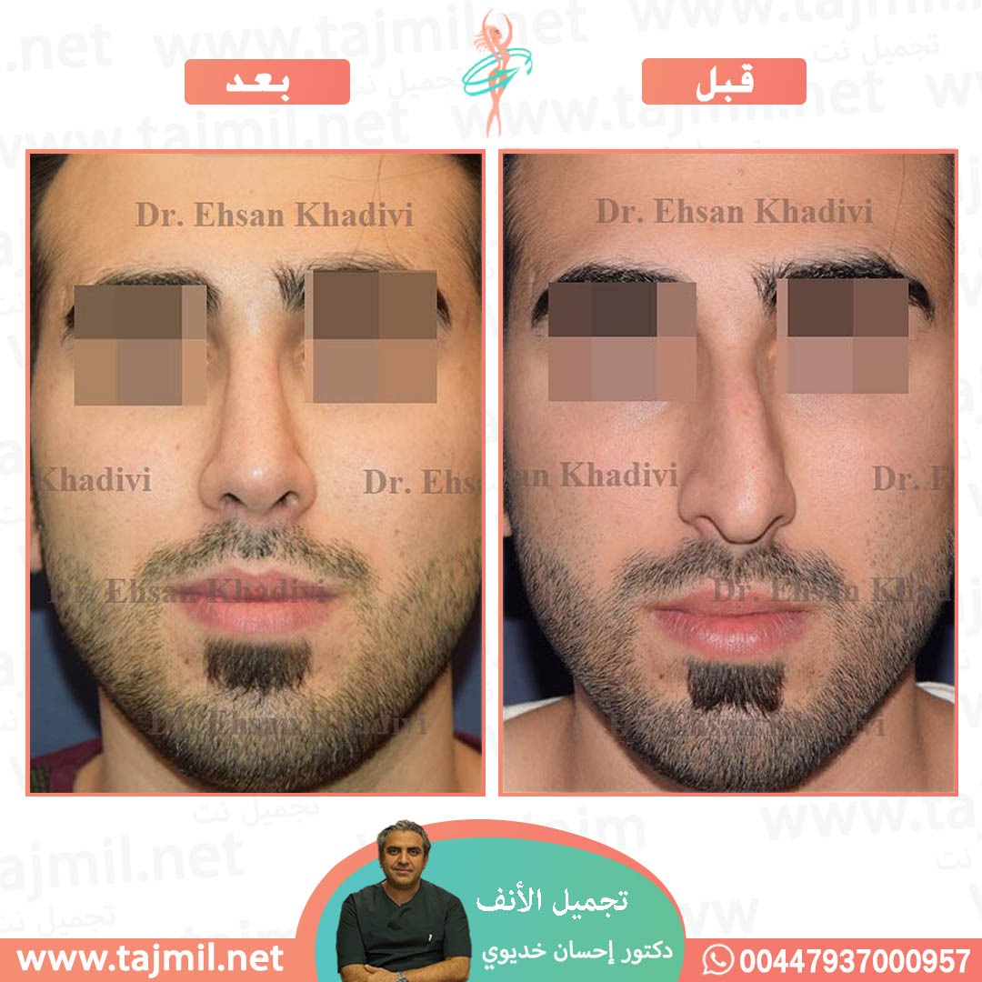  - دکتور إحسان خدیوي عملية تجميل الانف في ايران مع تجميل نت