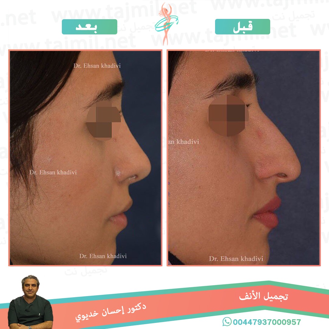  - دکتور إحسان خدیوي عملية تجميل الانف في ايران مع تجميل نت