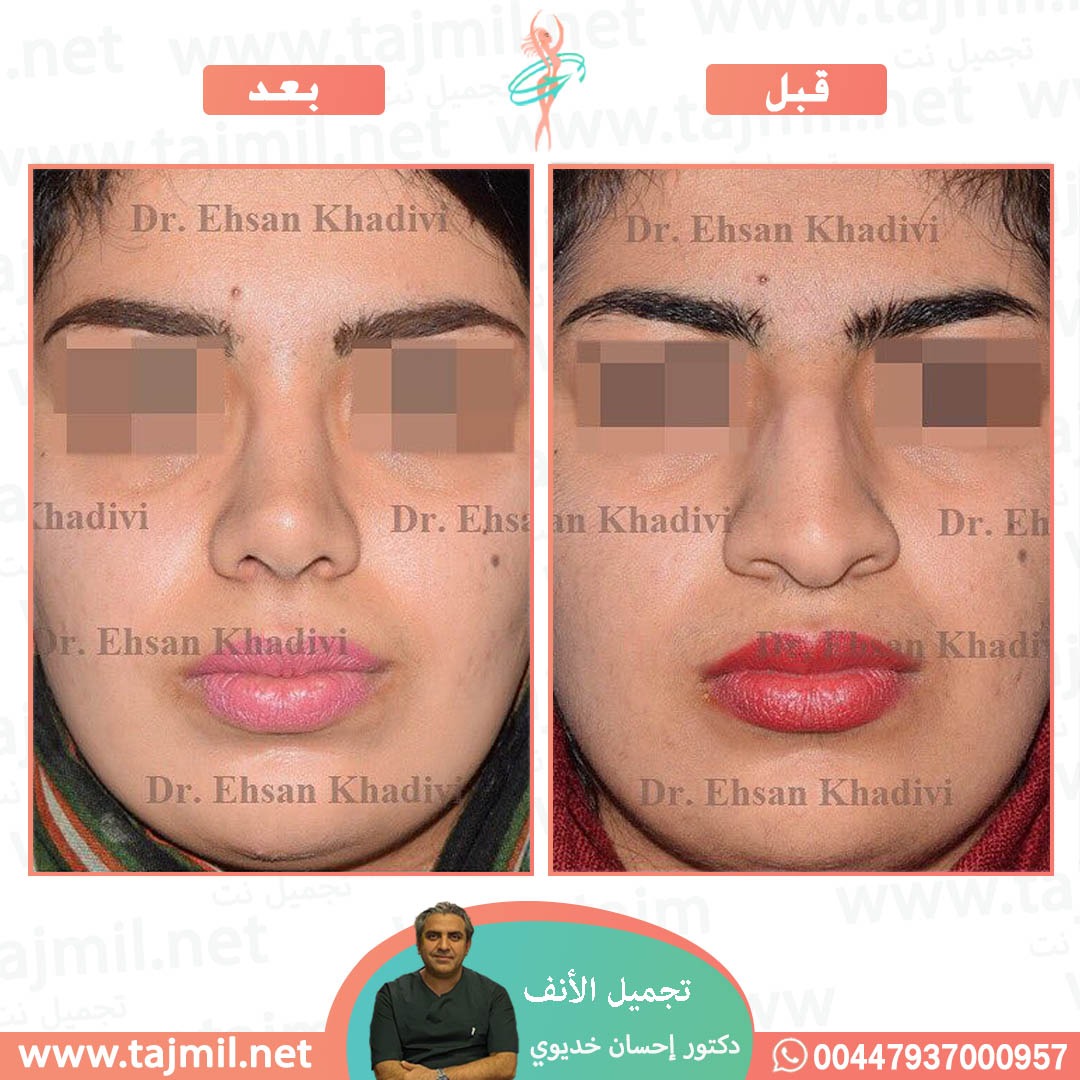  - دکتور إحسان خدیوي عملية تجميل الانف في ايران مع تجميل نت