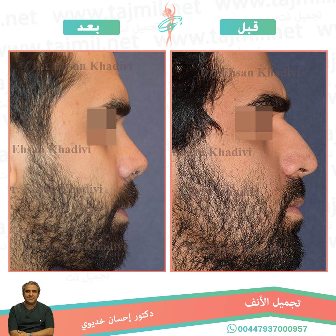  - دکتور إحسان خدیوي عملية تجميل الانف في ايران مع تجميل نت