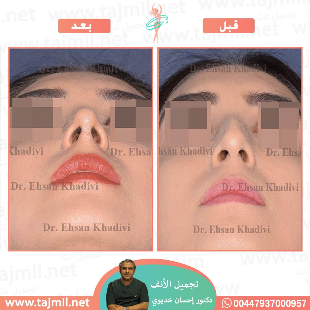  - دکتور إحسان خدیوي عملية تجميل الانف في ايران مع تجميل نت