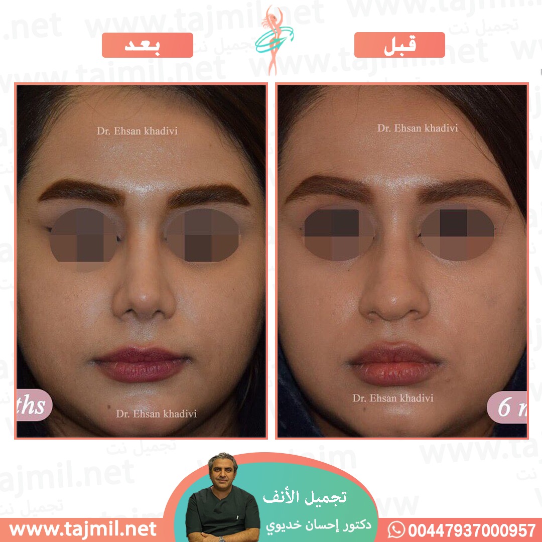  - دکتور إحسان خدیوي عملية تجميل الانف في ايران مع تجميل نت