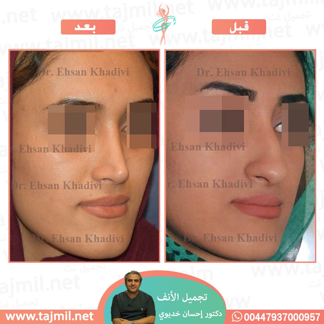  - دکتور إحسان خدیوي عملية تجميل الانف في ايران مع تجميل نت