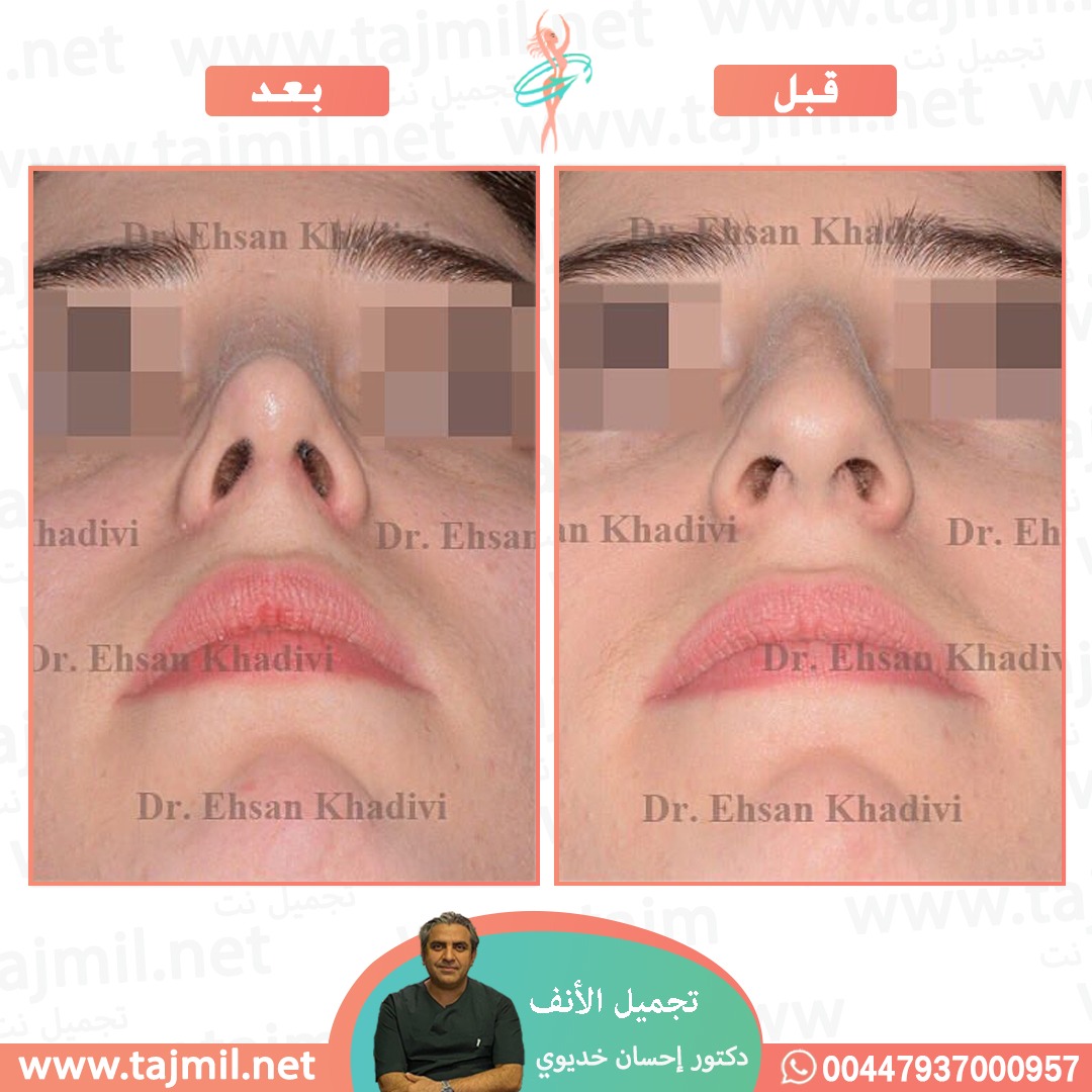  - دکتور إحسان خدیوي عملية تجميل الانف في ايران مع تجميل نت