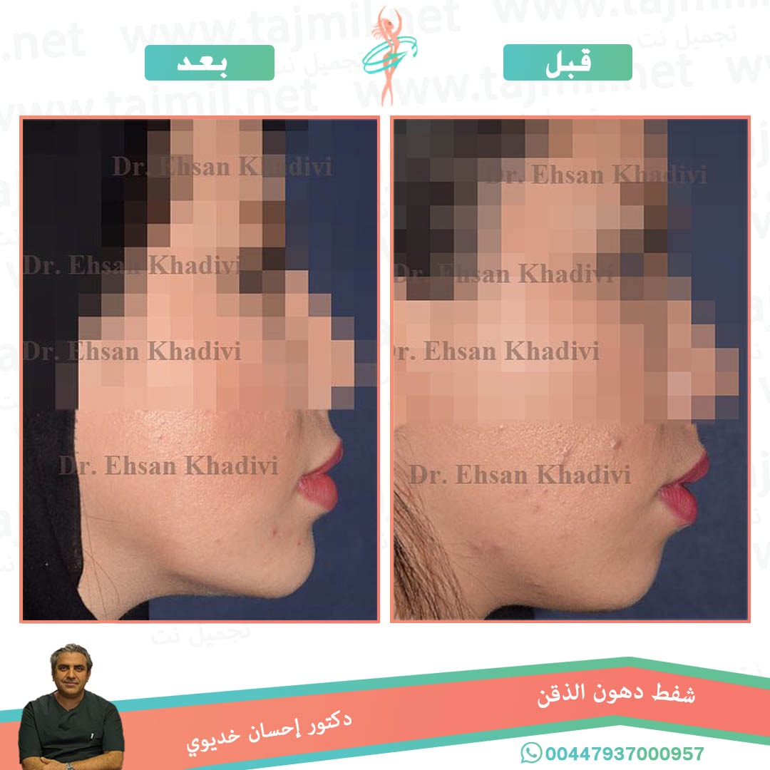  - دکتور إحسان خدیوي عملية تجميل الانف في ايران مع تجميل نت