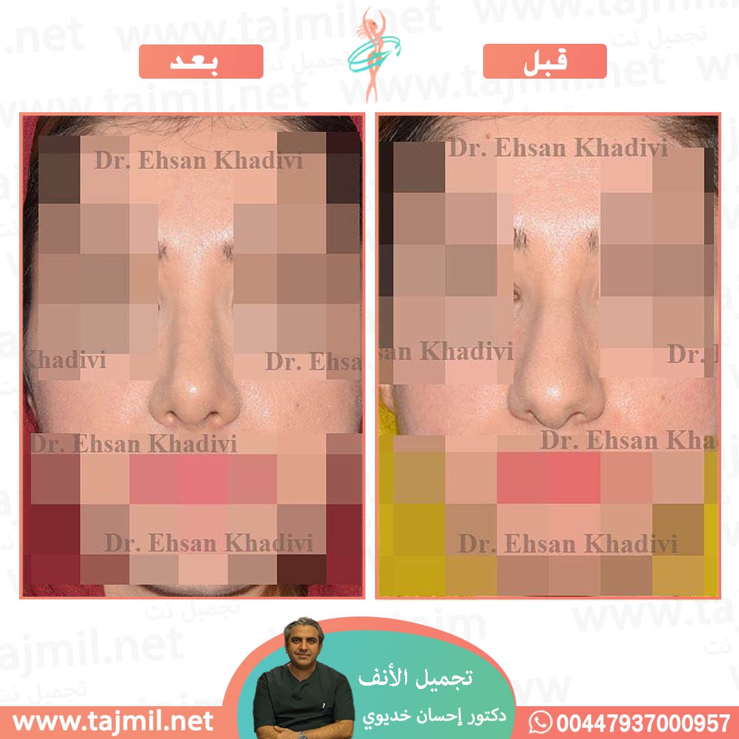  - دکتور إحسان خدیوي عملية تجميل الانف في ايران مع تجميل نت