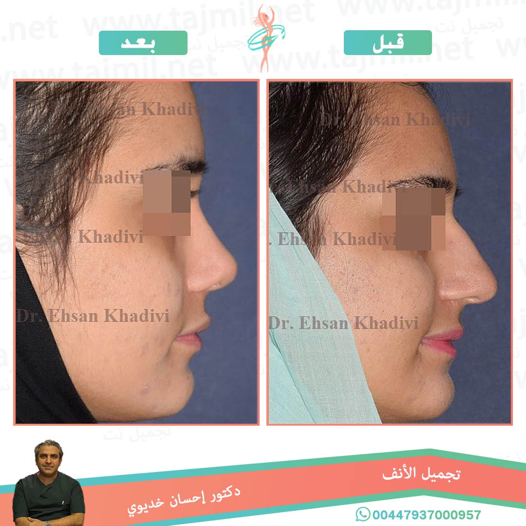  - دکتور إحسان خدیوي عملية تجميل الانف في ايران مع تجميل نت