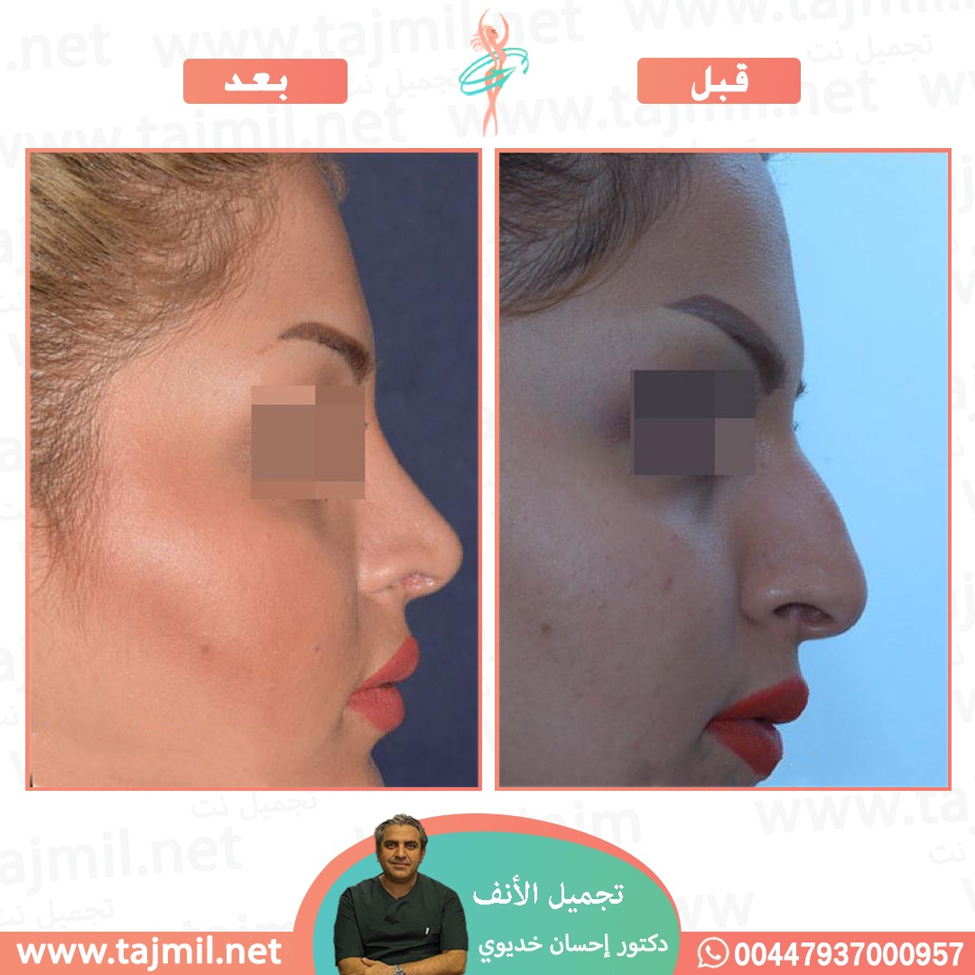  - دکتور إحسان خدیوي عملية تجميل الانف في ايران مع تجميل نت