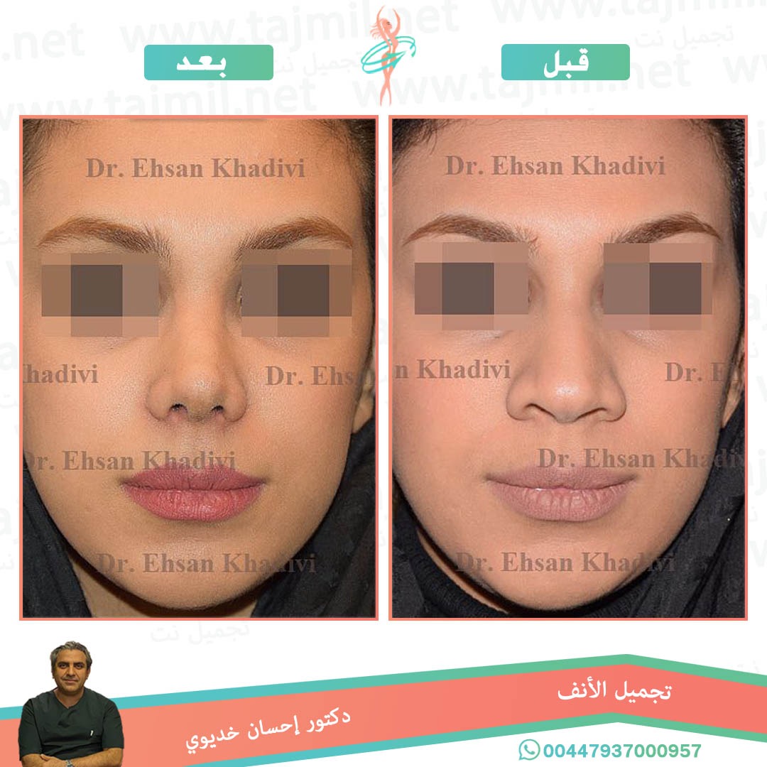  - دکتور إحسان خدیوي عملية تجميل الانف في ايران مع تجميل نت