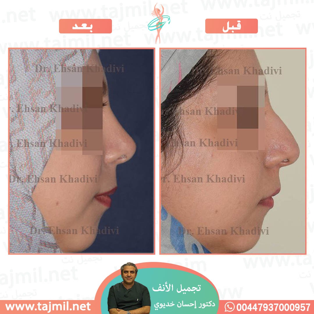  - دکتور إحسان خدیوي عملية تجميل الانف في ايران مع تجميل نت