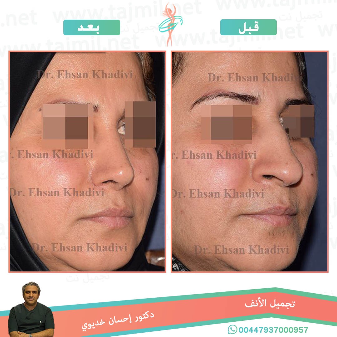  - دکتور إحسان خدیوي عملية تجميل الانف في ايران مع تجميل نت