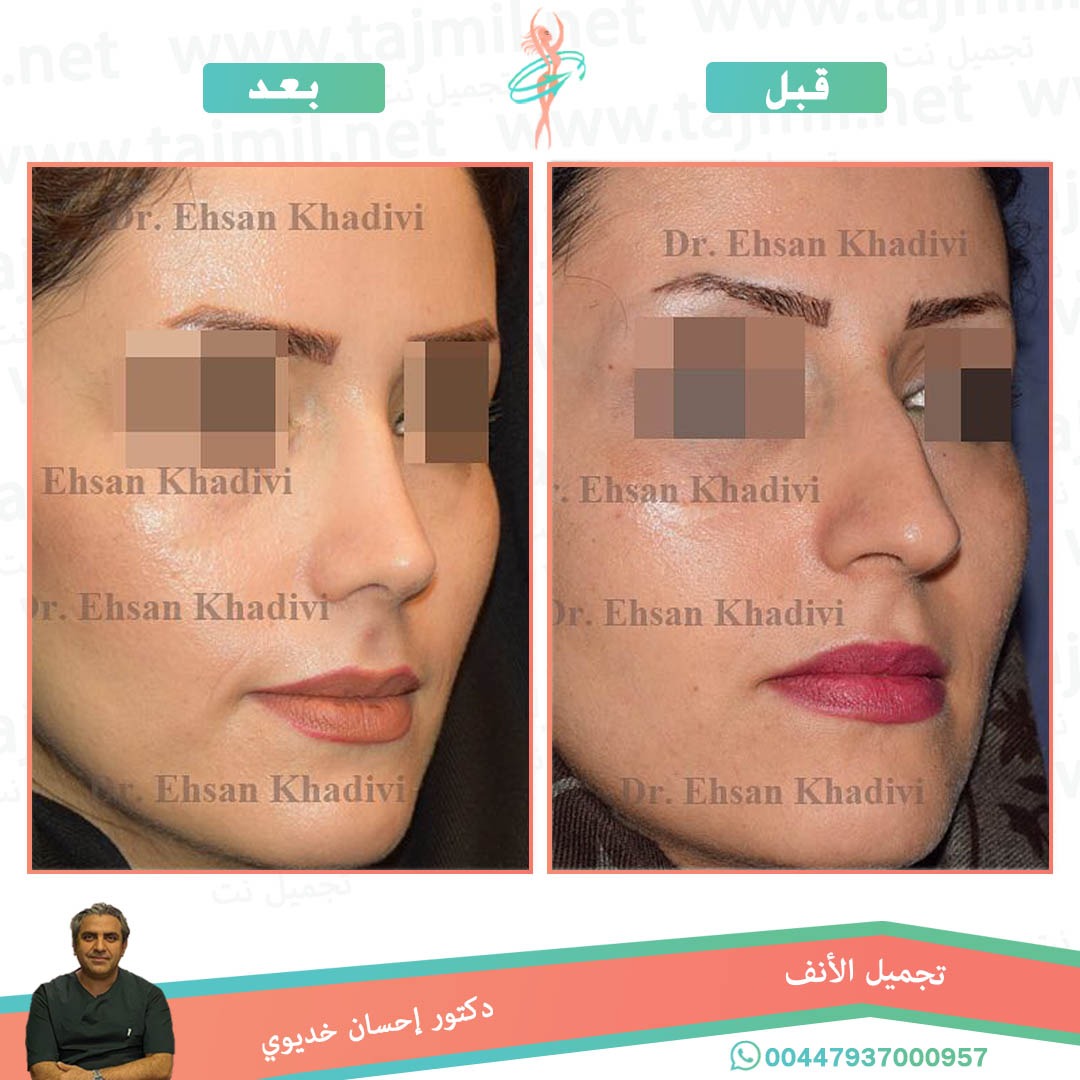  - دکتور إحسان خدیوي عملية تجميل الانف في ايران مع تجميل نت