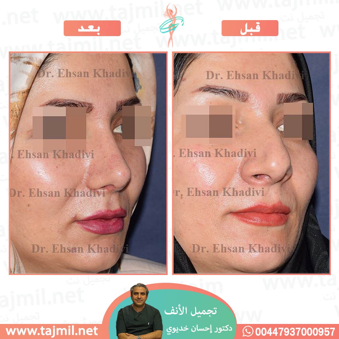  - دکتور إحسان خدیوي عملية تجميل الانف في ايران مع تجميل نت