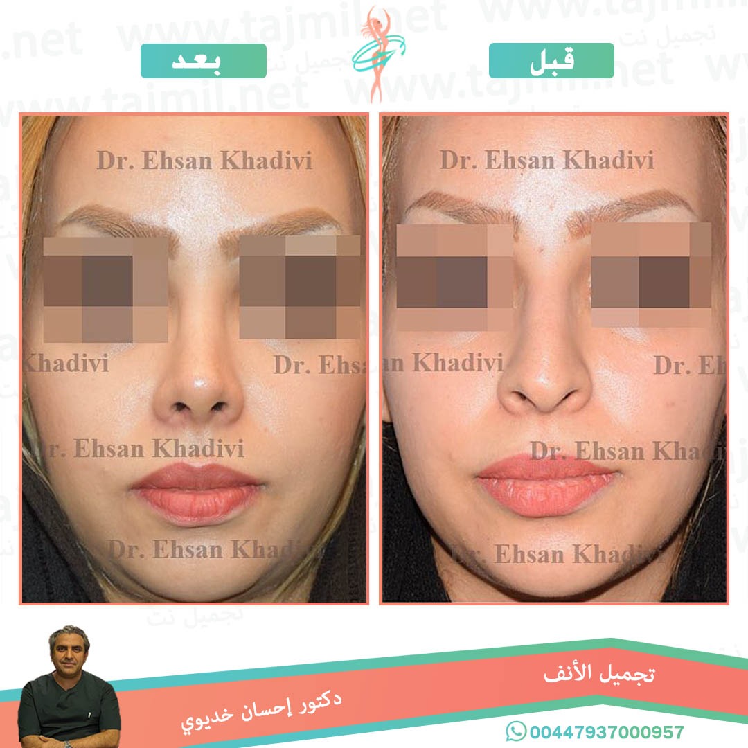  - دکتور إحسان خدیوي عملية تجميل الانف في ايران مع تجميل نت