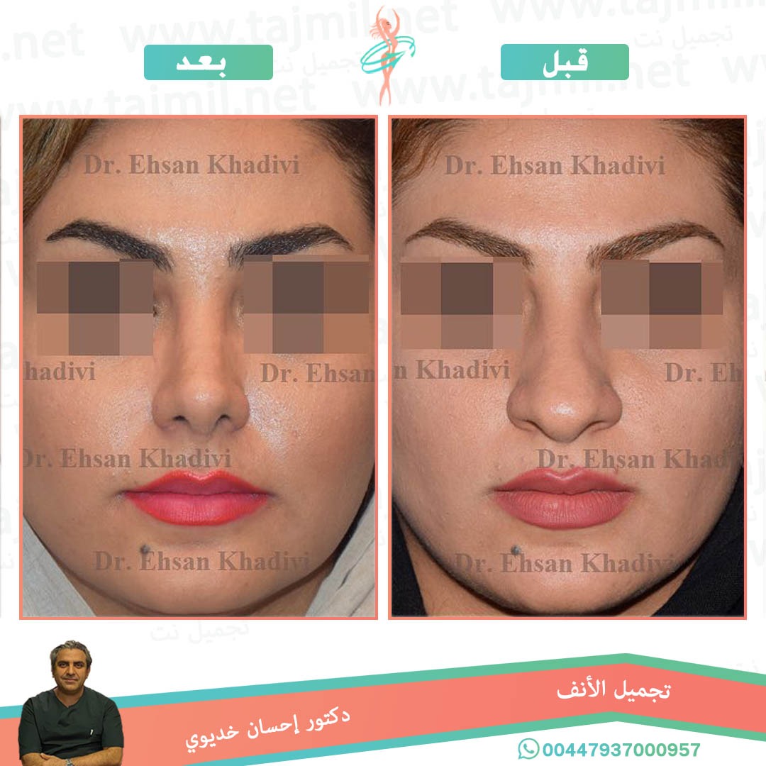  - دکتور إحسان خدیوي عملية تجميل الانف في ايران مع تجميل نت