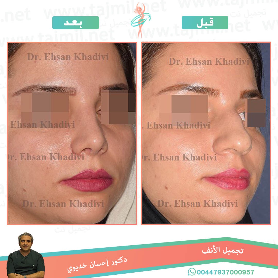  - دکتور إحسان خدیوي عملية تجميل الانف في ايران مع تجميل نت