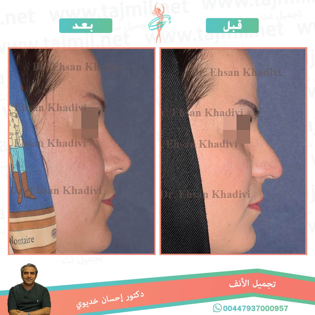  - دکتور إحسان خدیوي عملية تجميل الانف في ايران مع تجميل نت