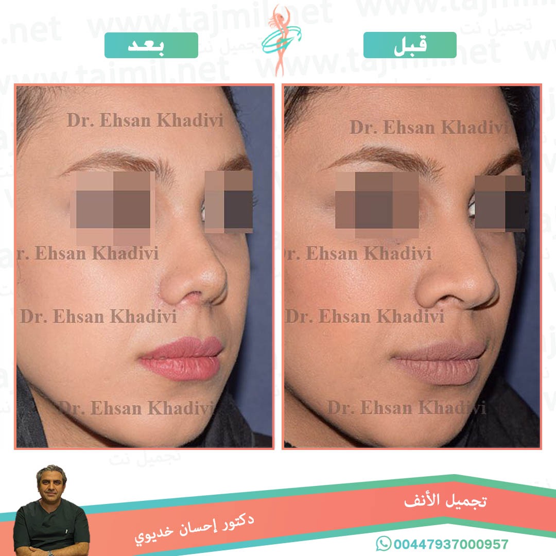  - دکتور إحسان خدیوي عملية تجميل الانف في ايران مع تجميل نت