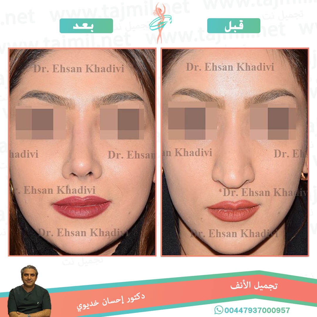  - دکتور إحسان خدیوي عملية تجميل الانف في ايران مع تجميل نت