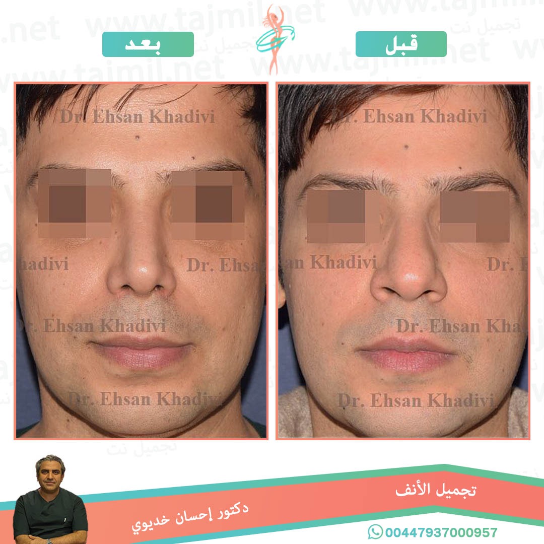  - دکتور إحسان خدیوي عملية تجميل الانف في ايران مع تجميل نت