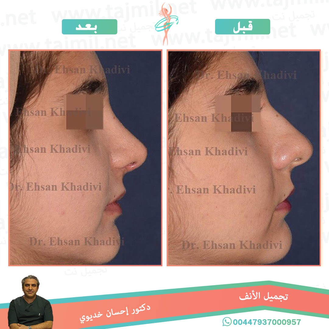  - دکتور إحسان خدیوي عملية تجميل الانف في ايران مع تجميل نت