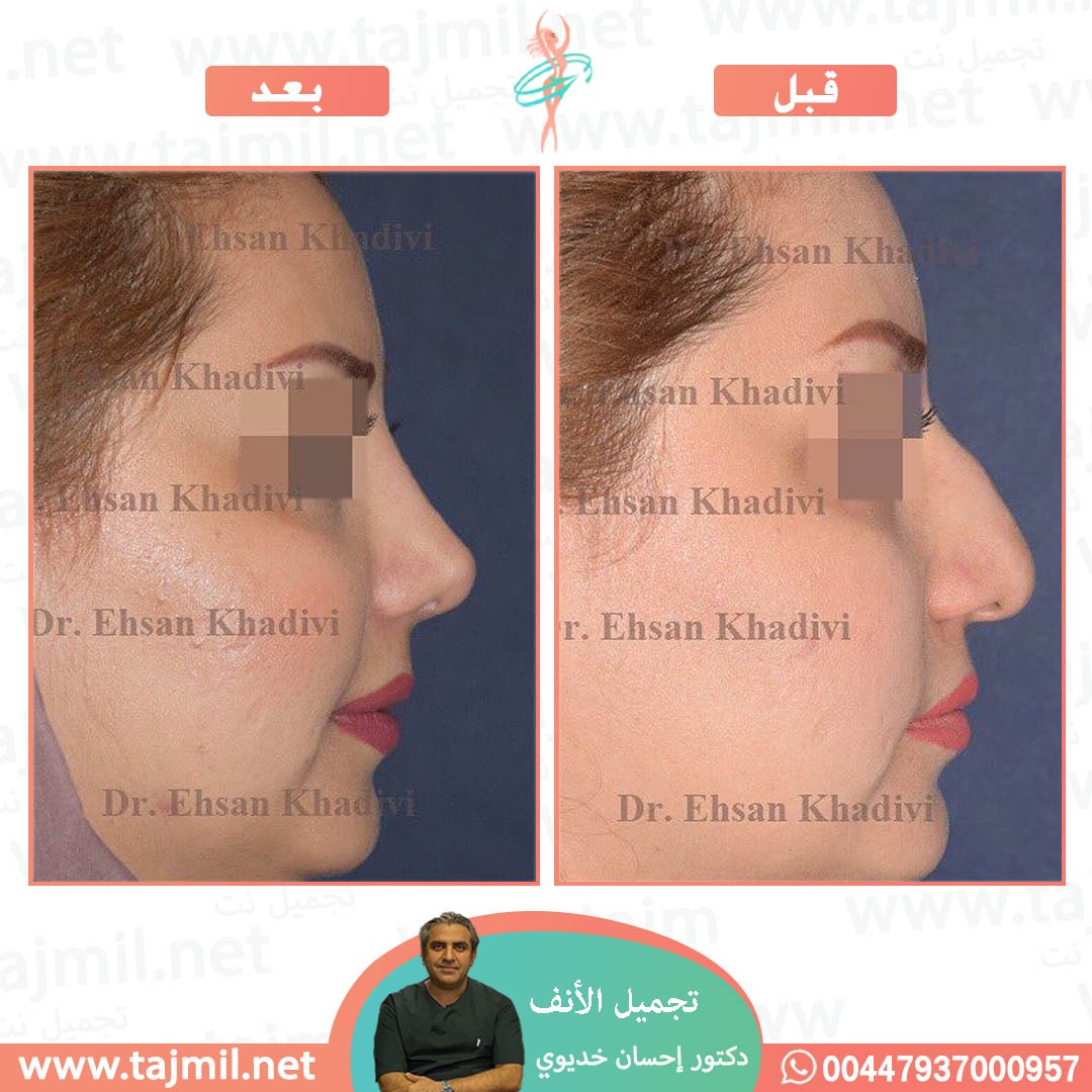  - دکتور إحسان خدیوي عملية تجميل الانف في ايران مع تجميل نت